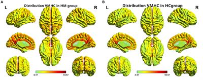Abnormal Functional Connectivity Between Cerebral Hemispheres in Patients With High Myopia: A Resting FMRI Study Based on Voxel-Mirrored Homotopic Connectivity